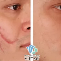 Các phương pháp điều trị sẹo